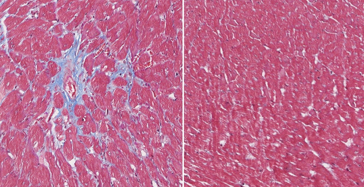 Imágenes con tinción del corazón de ratones utilizados en la investigación. A la izquierda, músculo cardiaco con fibrosis, una de las características de la distrofia muscular congénita asociada al gen LMNA, y a la derecha, corazón sin fibrosis tras recibir el tratamiento. Créditos: artículo 'CRISPR-mediated targeting of the LMNA c.745C>T mutation enhances survival and cardiac function in congenital muscular dystrophy', imagen cedida por Ignacio Pérez de Castro. 