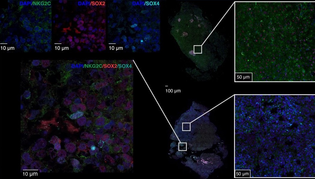 Imagen que muestra la expresión del receptor activador NKG2C en células tumorales de glioblastoma.